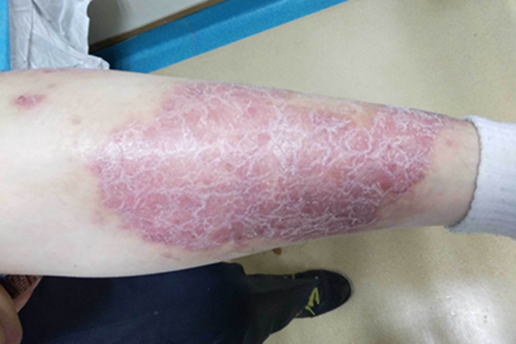 银屑病关节炎小腿红斑图 银屑病关节炎小腿红斑图