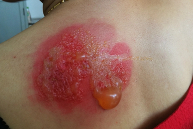 接触性皮炎背部水疱图