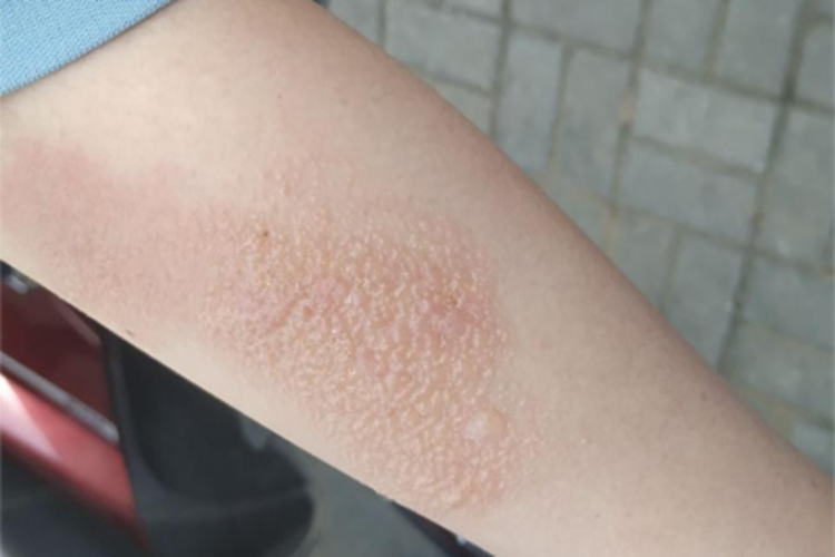 光接触性皮炎胳膊水疱图