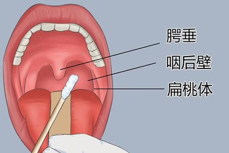 核酸采集咽后壁图片图片