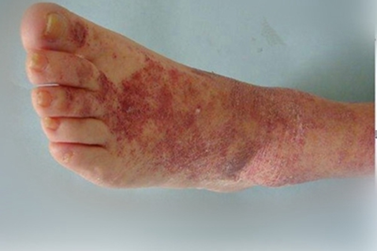 湿疹样紫癜脚背红斑图