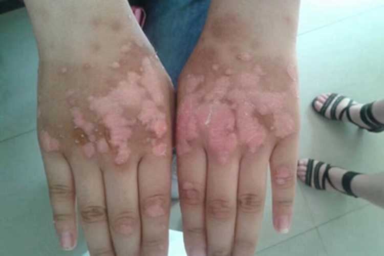 寻常型银屑病手背红斑图