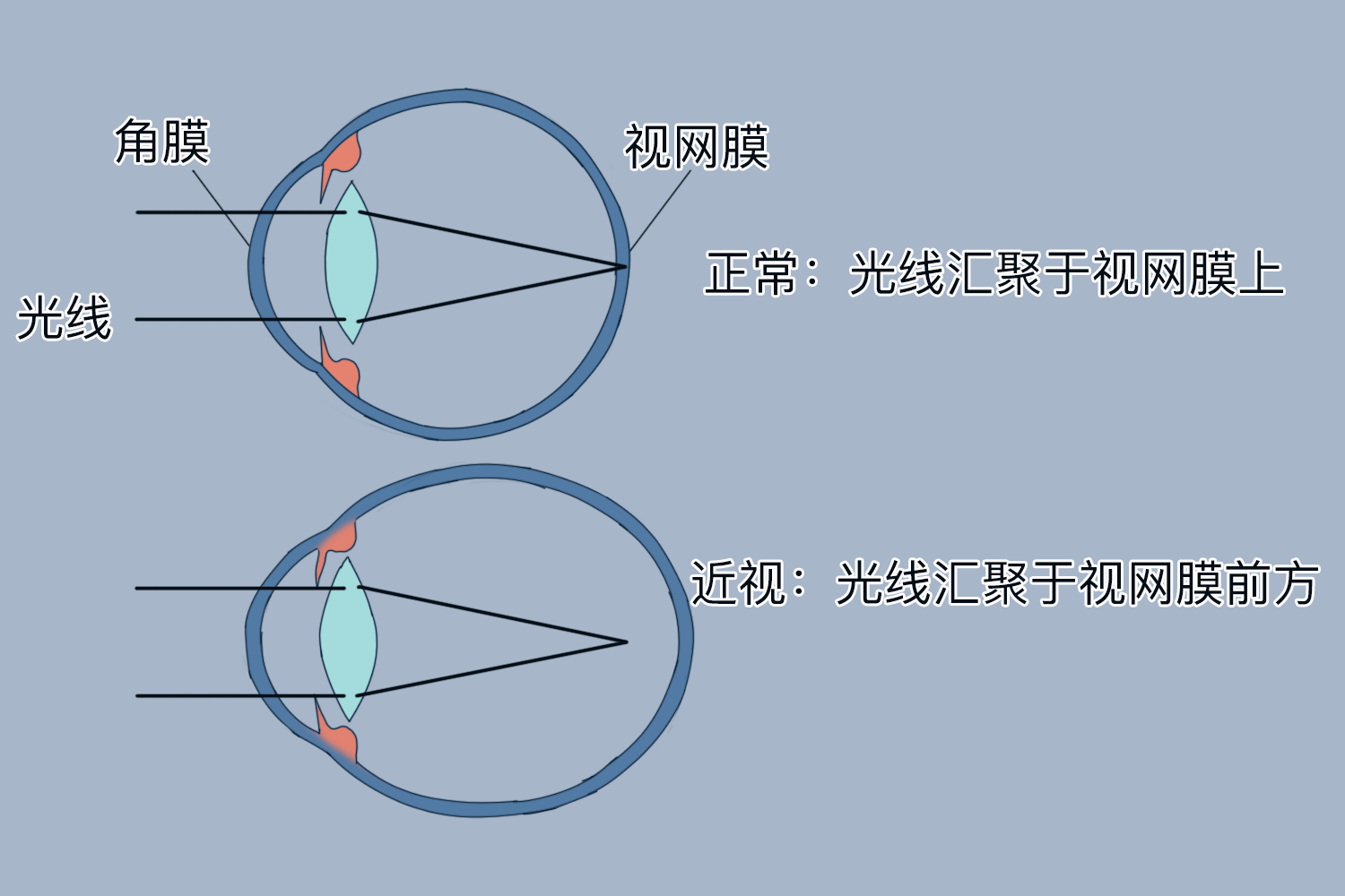 正视眼和近视眼的屈光状态图