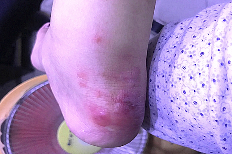 冻疮脚踝疙瘩图