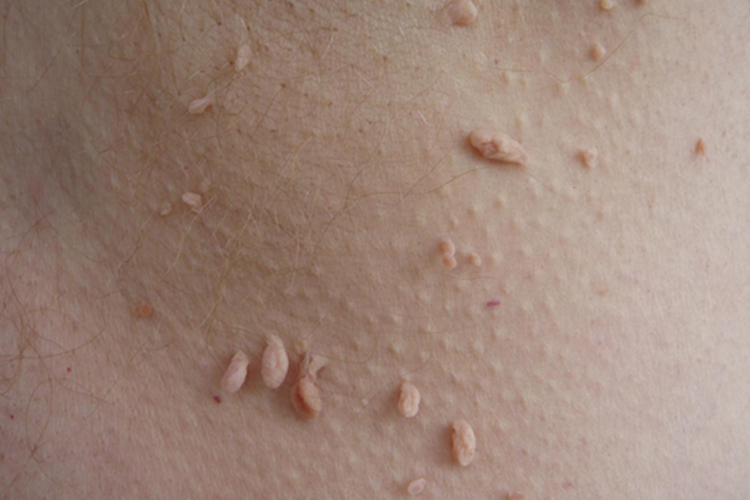 腋下指状疣图 腋下指状疣图