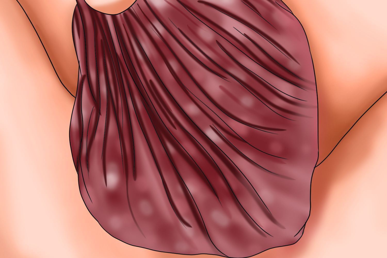 男性阴囊梅毒图