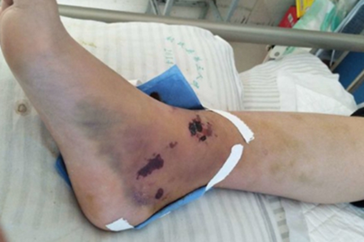 Ⅲ型踝关节骨折肿图