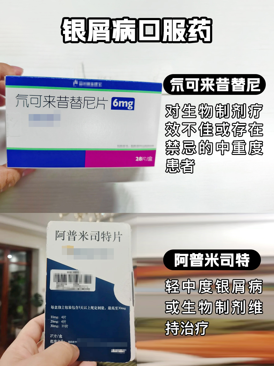 银屑病口服药-医生手把手教你对抗银屑病！