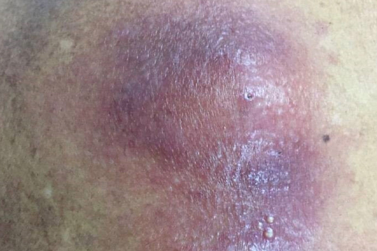 囊肿周围蜂窝组织炎图