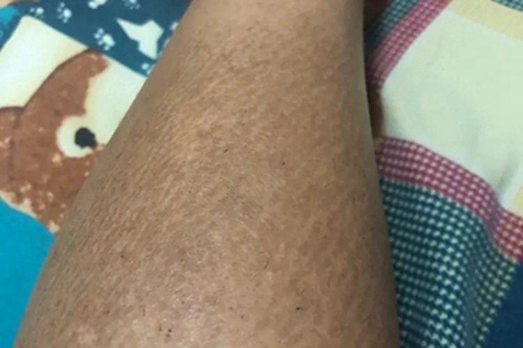 职业性黑变病小腿症状图