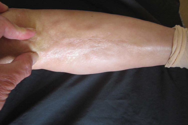 局限性硬皮病表面光滑发亮图 局限性硬皮病表面光滑发亮图