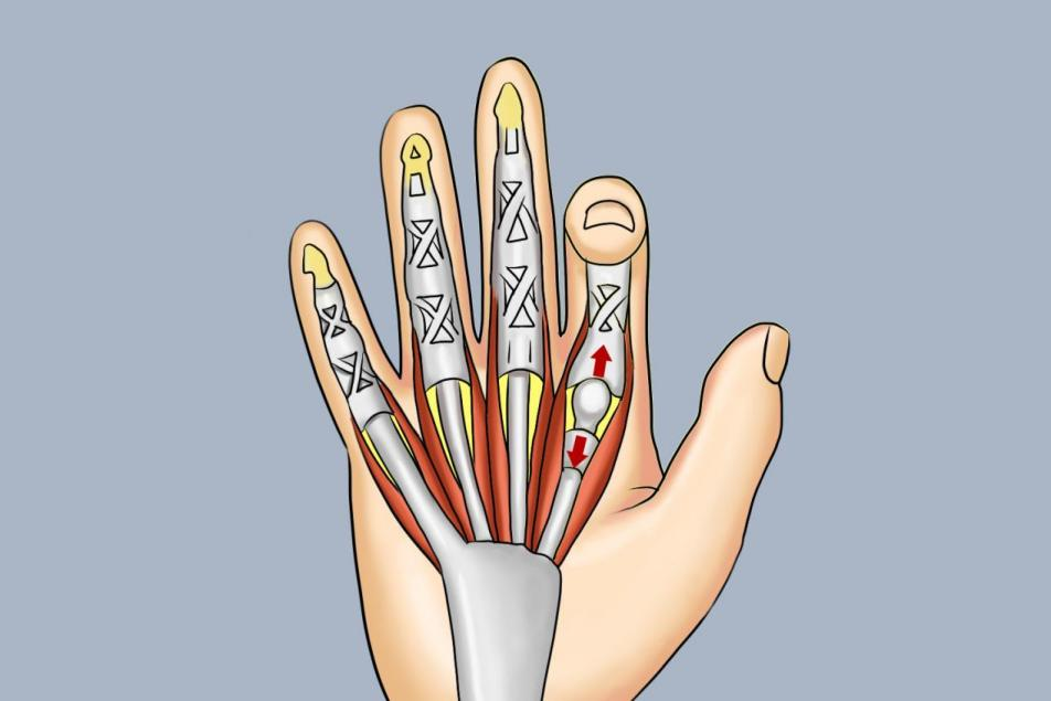 屈指肌腱腱鞘炎食指疼痛图