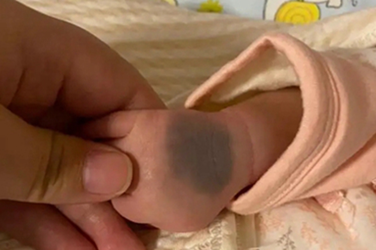 伊藤痣手背斑图 伊藤痣手背斑图