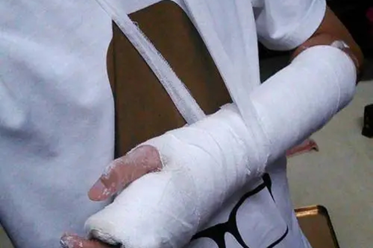 手腕石膏包扎图