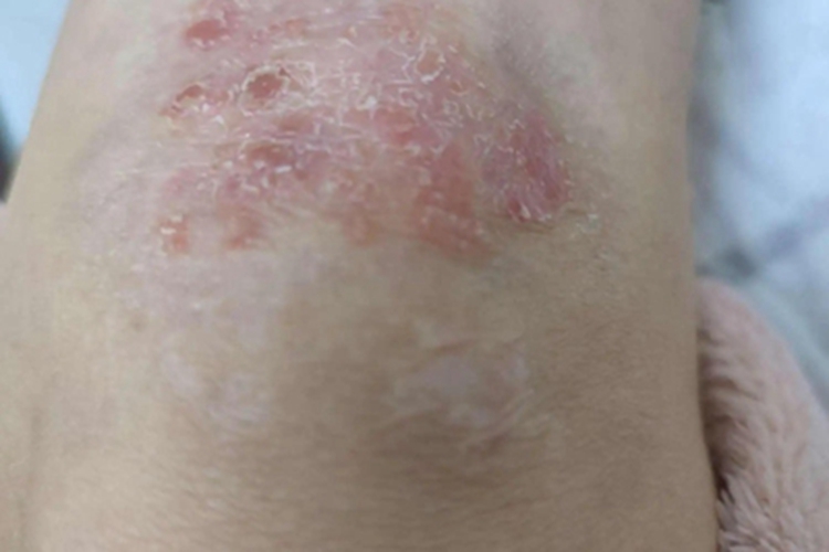 急性湿疹膝盖红斑脱屑图 急性湿疹膝盖红斑脱屑图