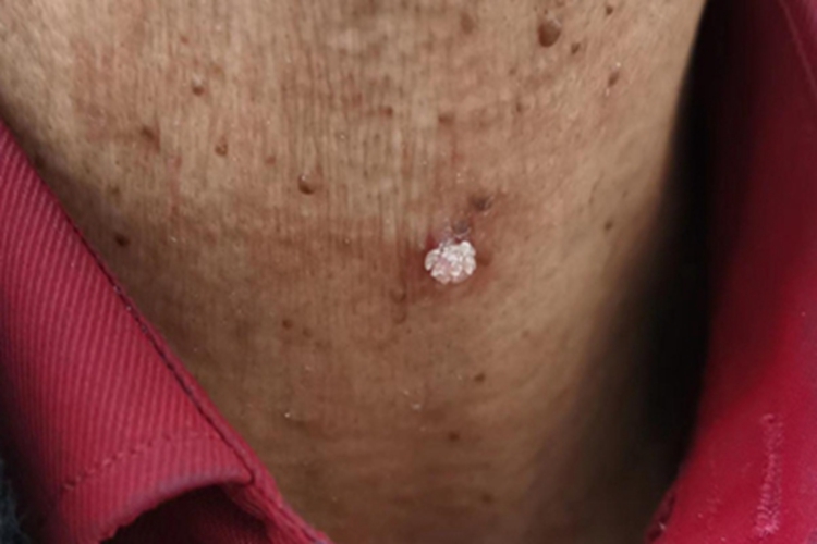 寻常疣颈部症状图 寻常疣颈部症状图