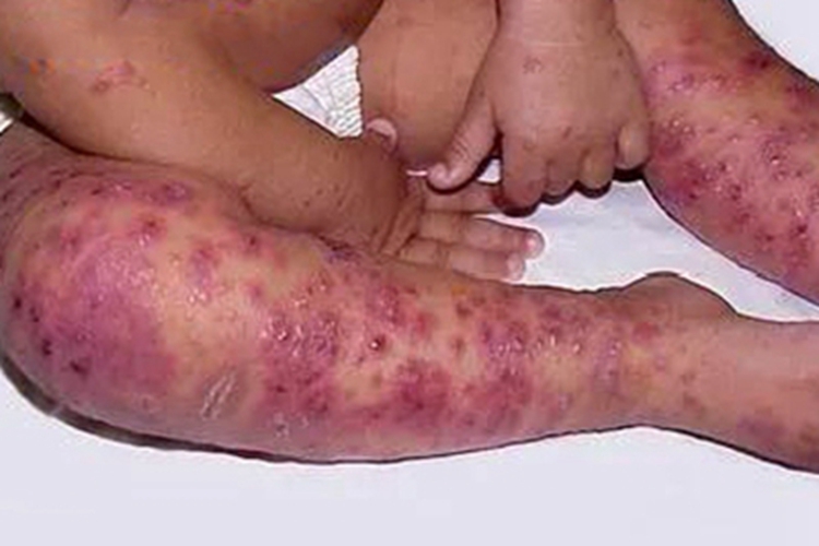 卡波西水痘样疹腿丘疹图