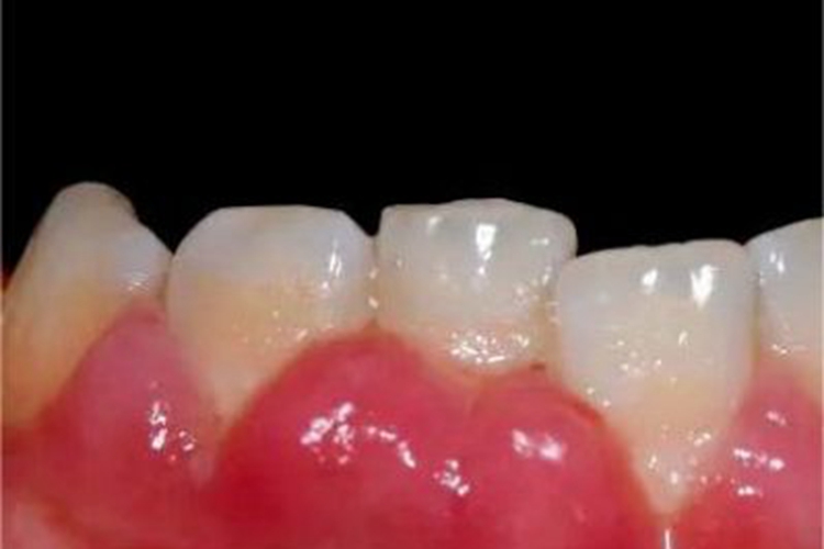 青春期龈炎牙龈有肉球图 青春期龈炎牙龈有肉球图