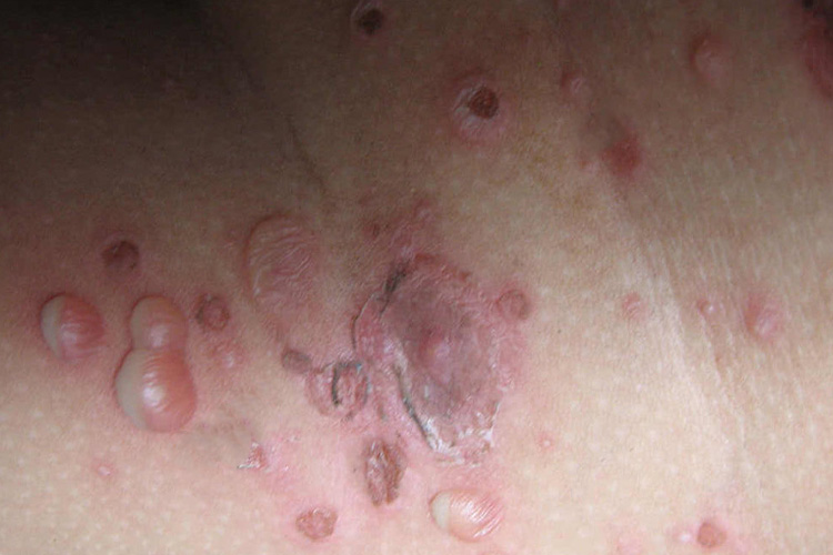 大疱性脓疱疮图