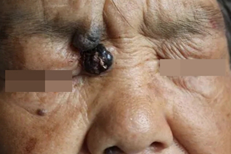 恶性黑色素瘤面部结节图 恶性黑色素瘤面部结节图