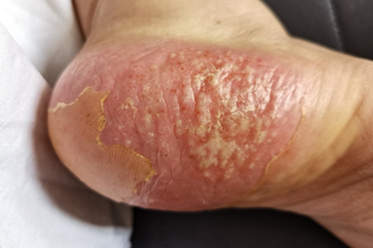 汗疱疹脚后跟脱皮图 汗疱疹脚后跟脱皮图