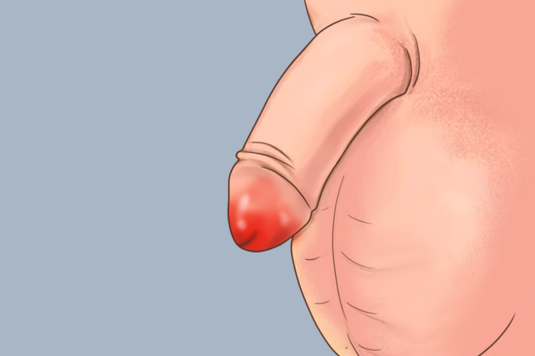 泌尿道感染尿道口红肿发炎图 泌尿道感染尿道口红肿发炎图