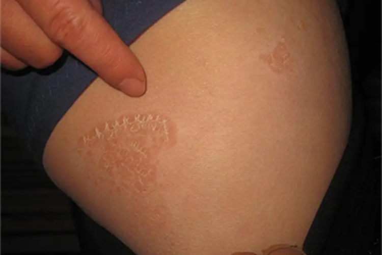 连圈状秕糠疹鳞屑图 连圈状秕糠疹鳞屑图