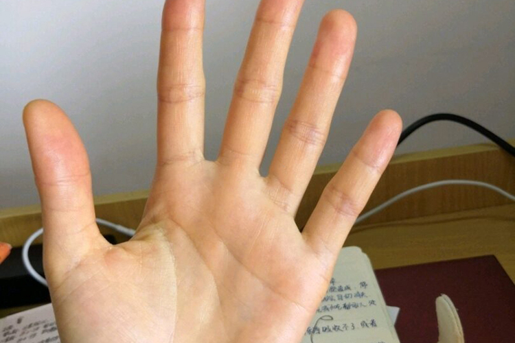 急性黄疸型肝炎手黄褐色图