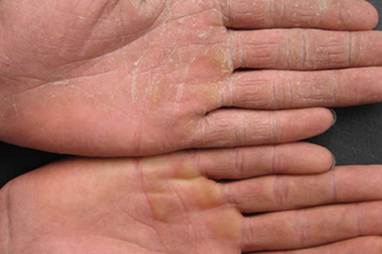 慢性湿疹皲裂图 慢性湿疹皲裂图