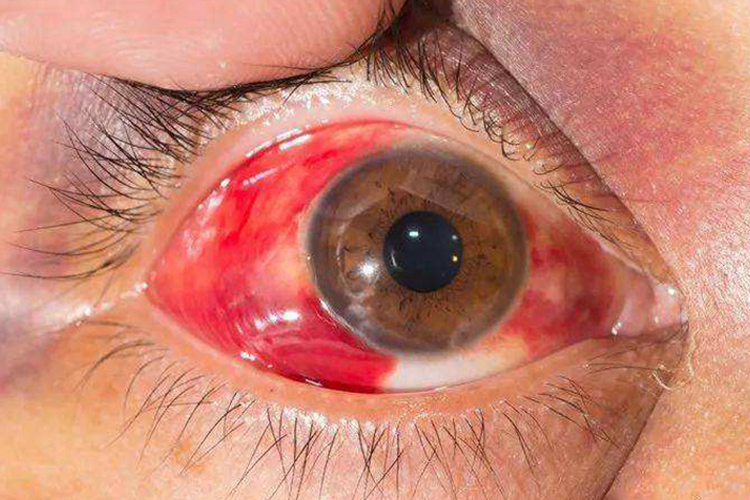 眼角膜外露图 眼角膜外露图