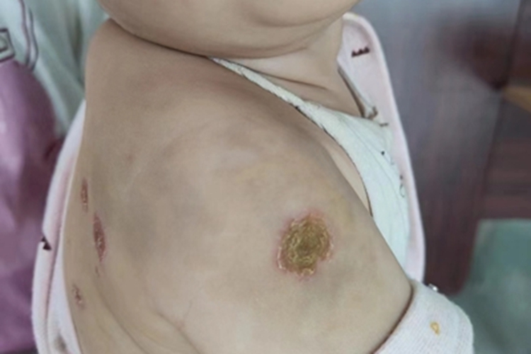 非大疱型脓疱疮胳膊黄痂图 非大疱型脓疱疮胳膊黄痂图