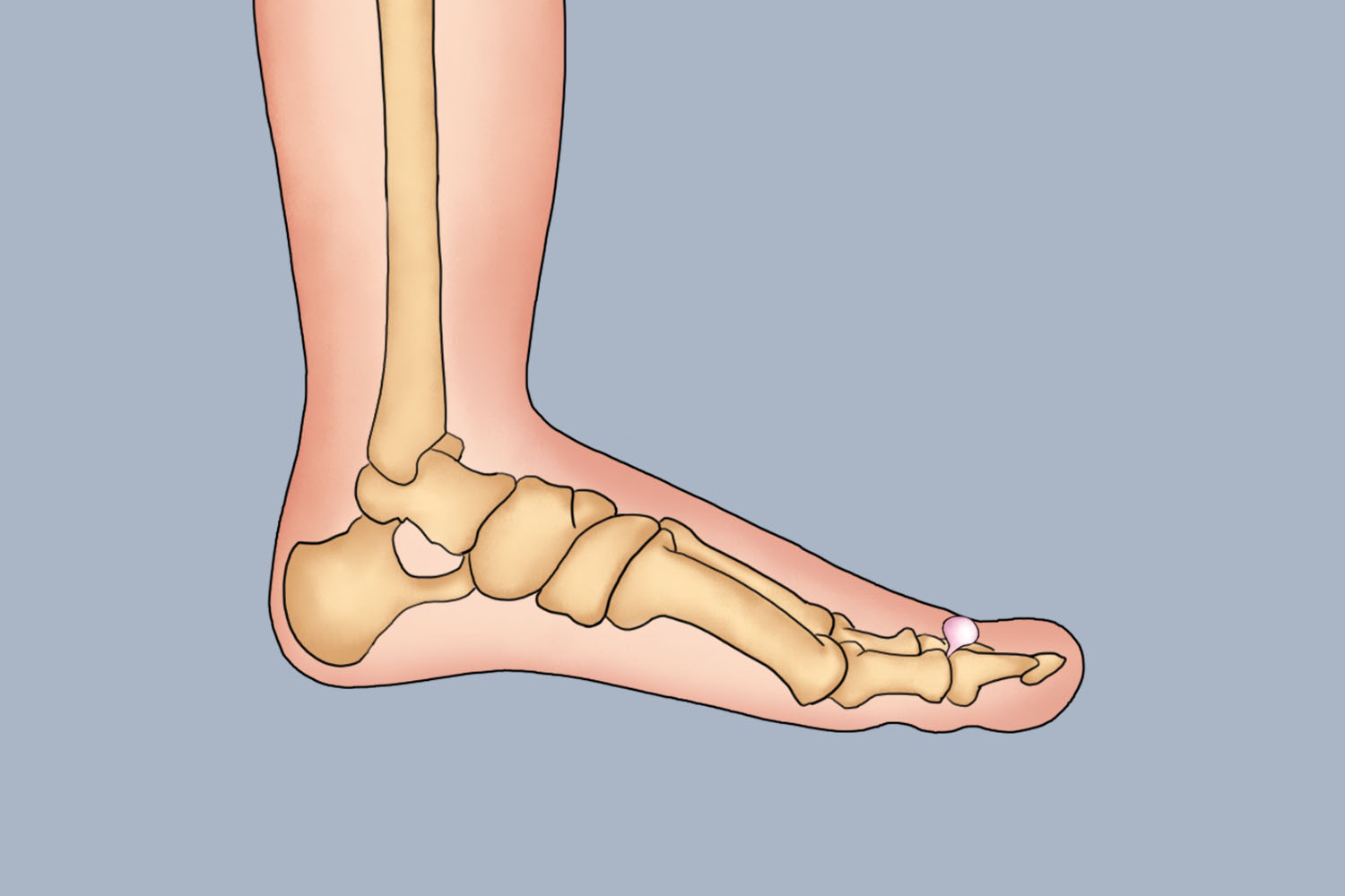 脚大拇指腱鞘炎图