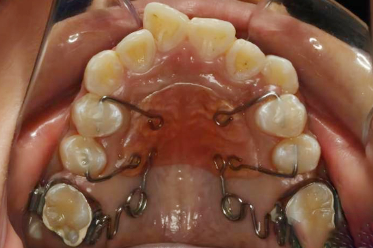 牙齿片段弓矫正图片图片