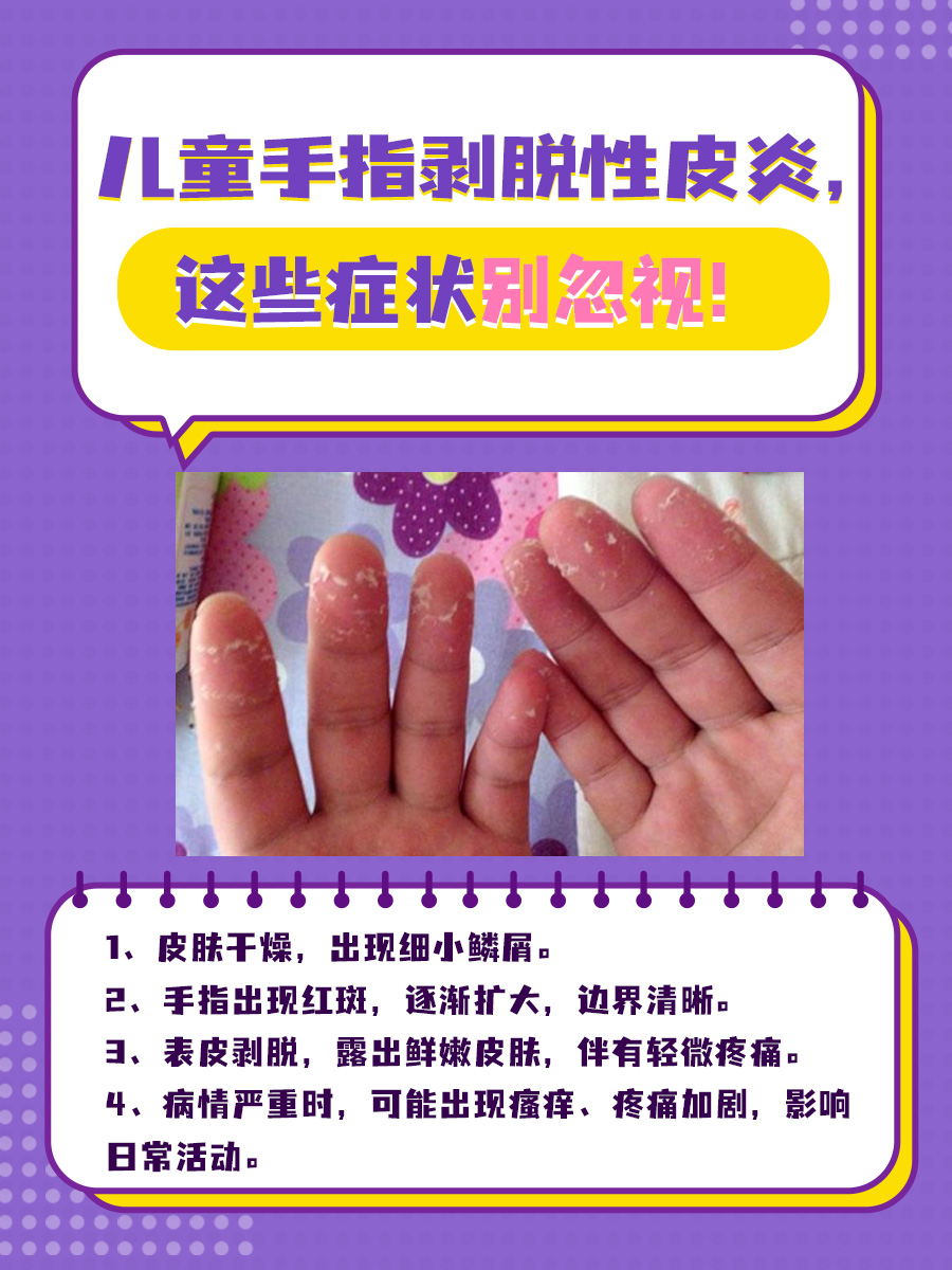 宝宝手指脱皮，警惕剥脱性皮炎！症状、处理解析