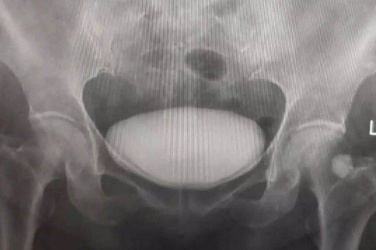 膀胱膨出Ⅰ度图