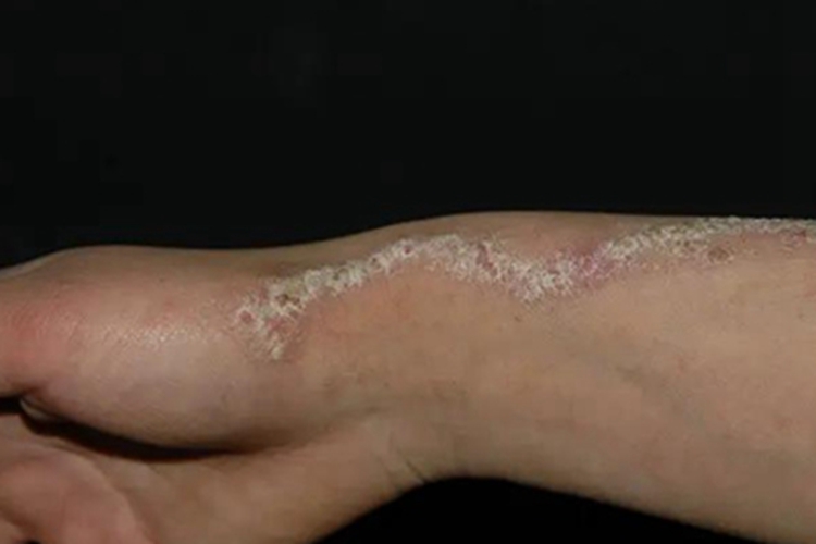 表皮痣手腕结痂图 表皮痣手腕结痂图