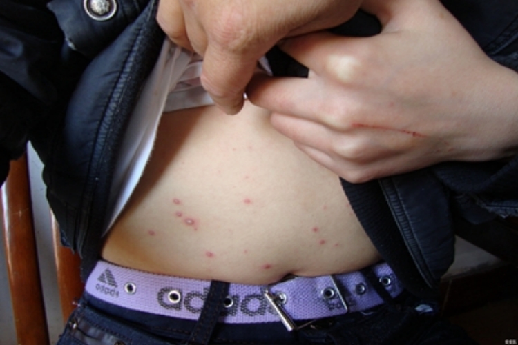 水痘中腹部有深红色疙瘩图