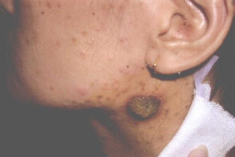 艾滋病传染性软疣图 艾滋病传染性软疣图