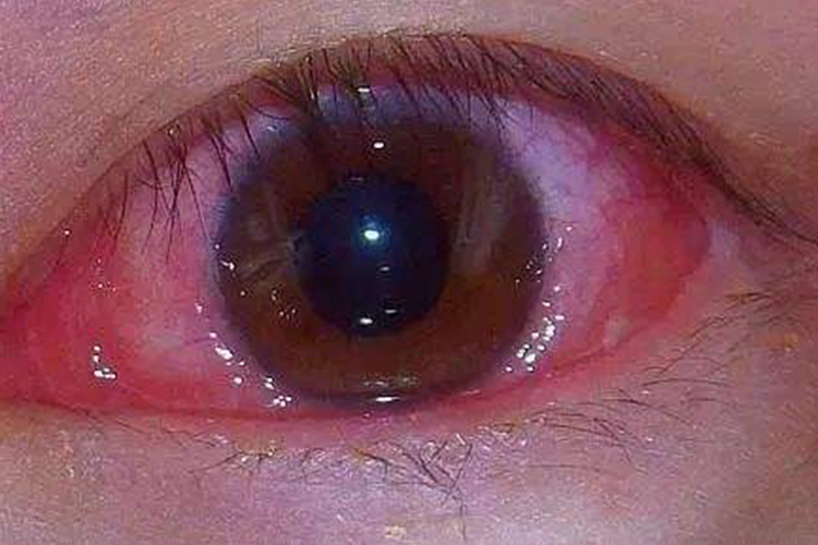 轻度眼角膜碱性烧伤图