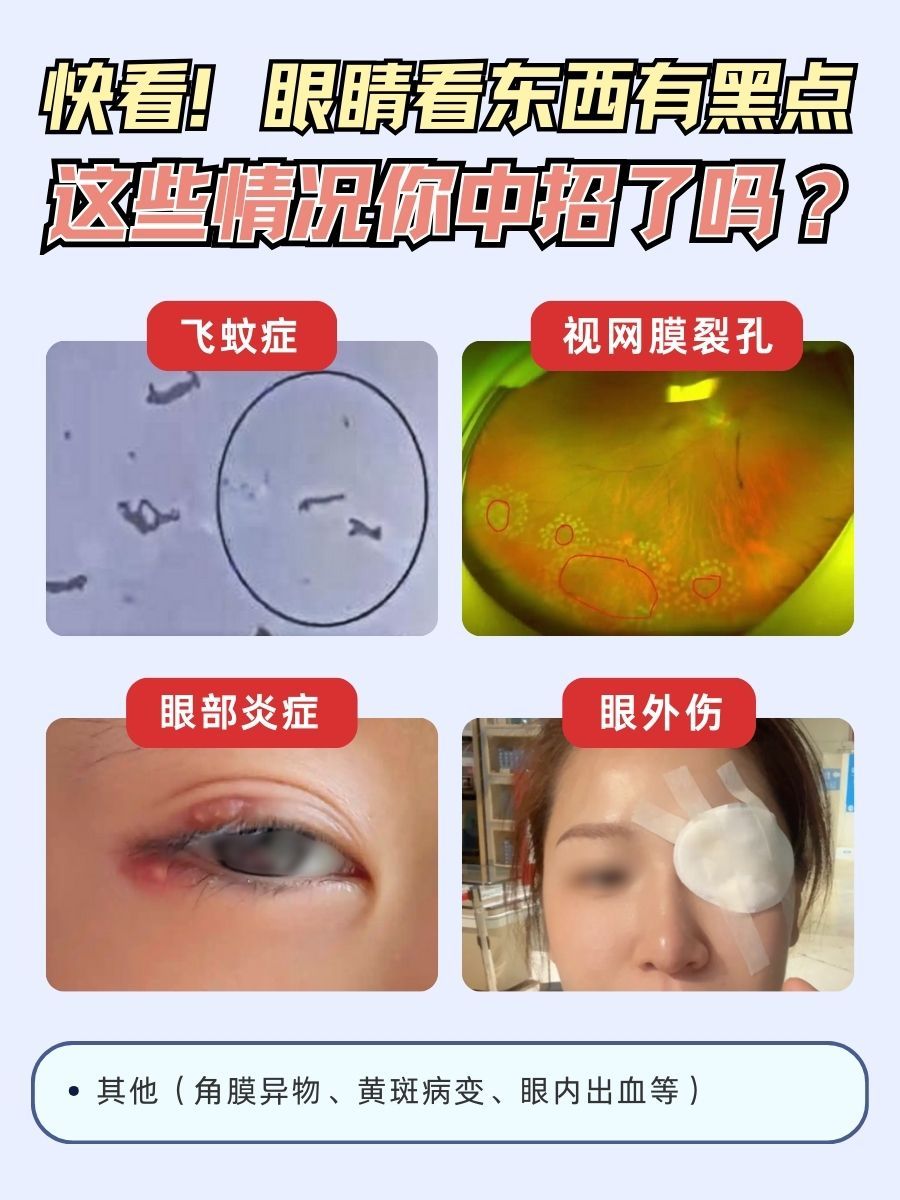快看！眼睛看东西有黑点，这些情况你中招了吗？