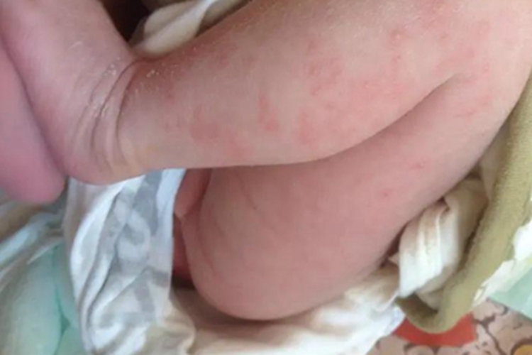 干燥型婴儿湿疹腿症状图