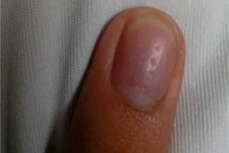 维生素A缺乏症手指甲点状凹陷图
