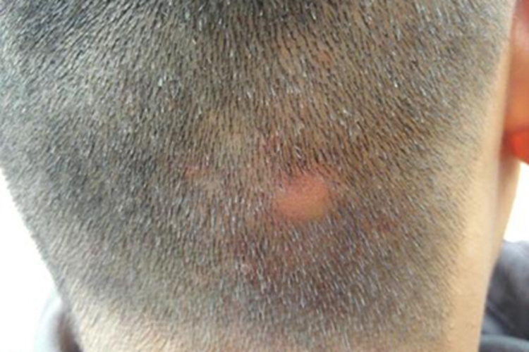 水痘头皮上出现很多红疙瘩图