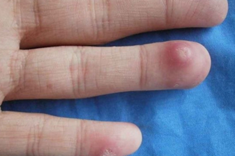 经典型上皮样肉瘤手指症状图 经典型上皮样肉瘤手指症状图