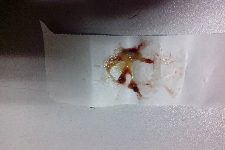 肺炎链球菌肺炎褐色痰液图