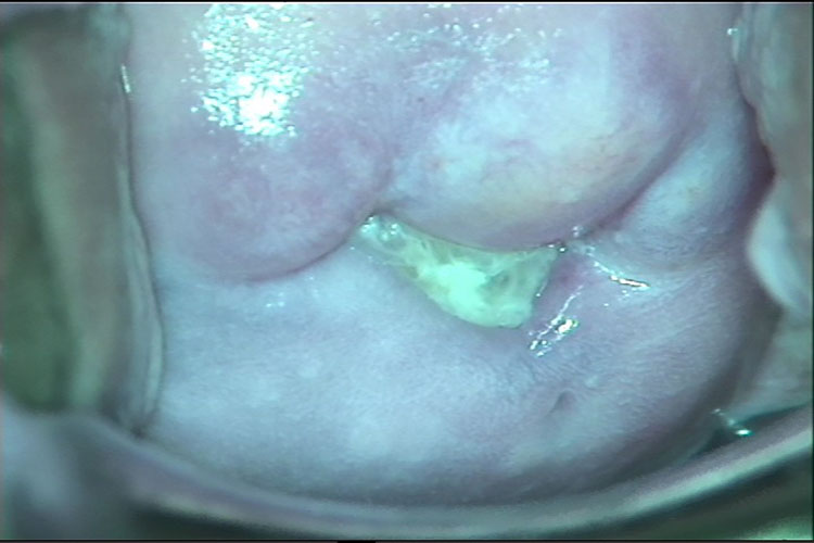 细菌性阴道病图