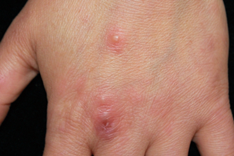 白塞病手背上有红丘疹图 白塞病手背上有红丘疹图