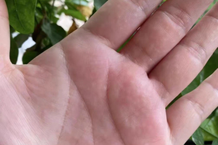 汗疱疹手掌长小疙瘩图