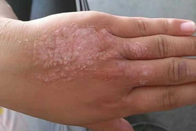慢性湿疹手部脱屑图 慢性湿疹手部脱屑图
