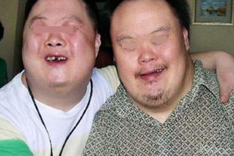 唐氏儿脖子短粗图